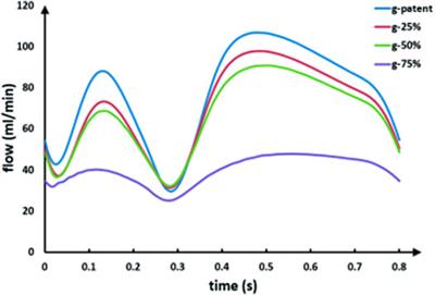 A Novel Method to Determine the Cause of Left Internal Mammary Artery Instant Non-Patency Based on Transit Time Flow Measurement